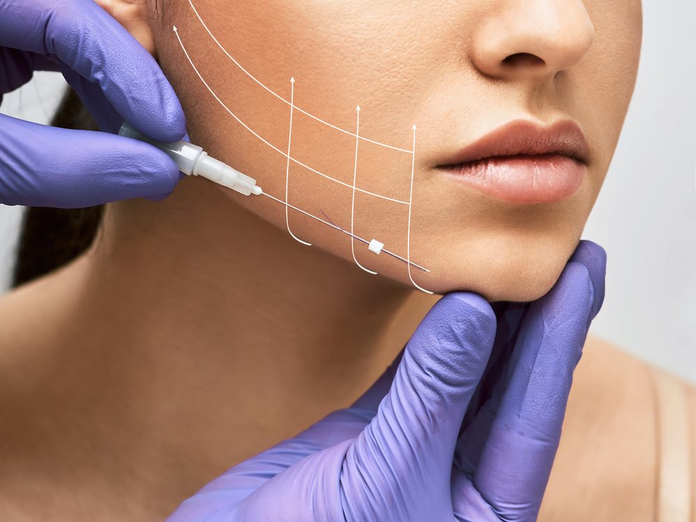 Thread Lift in Libertyville Thread Lift in Libertyville, Thread Lifts in Libertyville, alc medspa thread lift, get a thread lift in libertyville